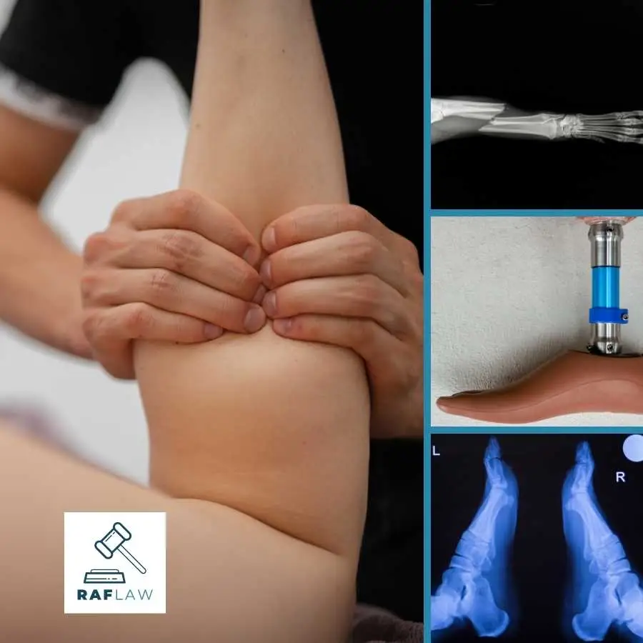 Hands Assessing Knee Joint with X-ray and Prosthetic Foot Images, Highlighting Leg Injury Assessments for RAF Law Claims