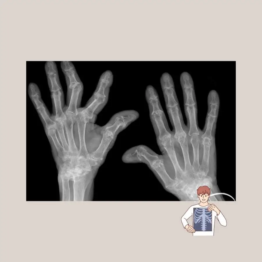 X-ray images of human hands showing bone structure and joints